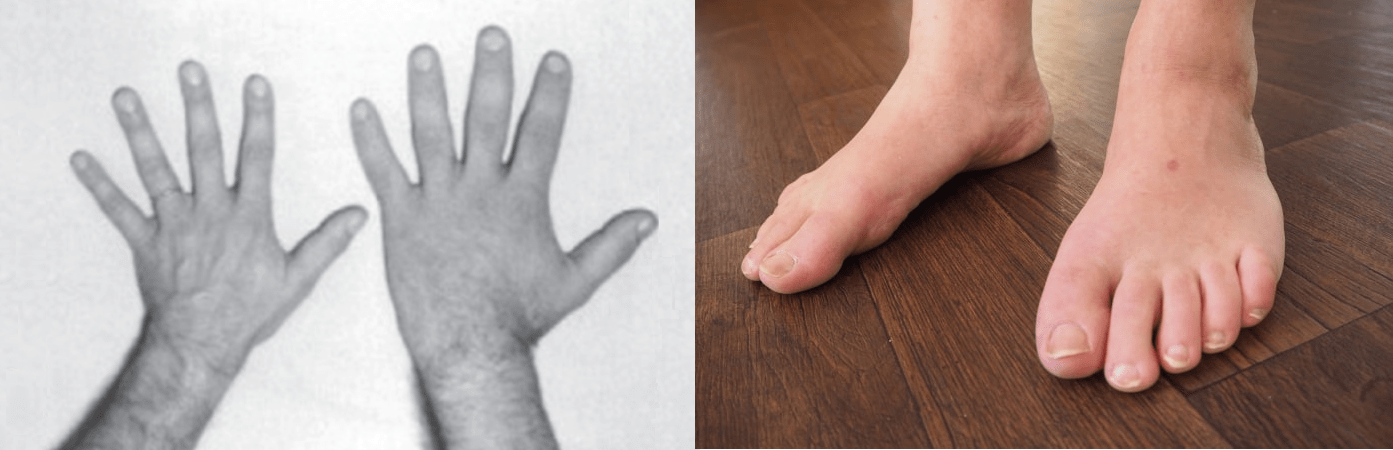 Handen en voeten acromegalie