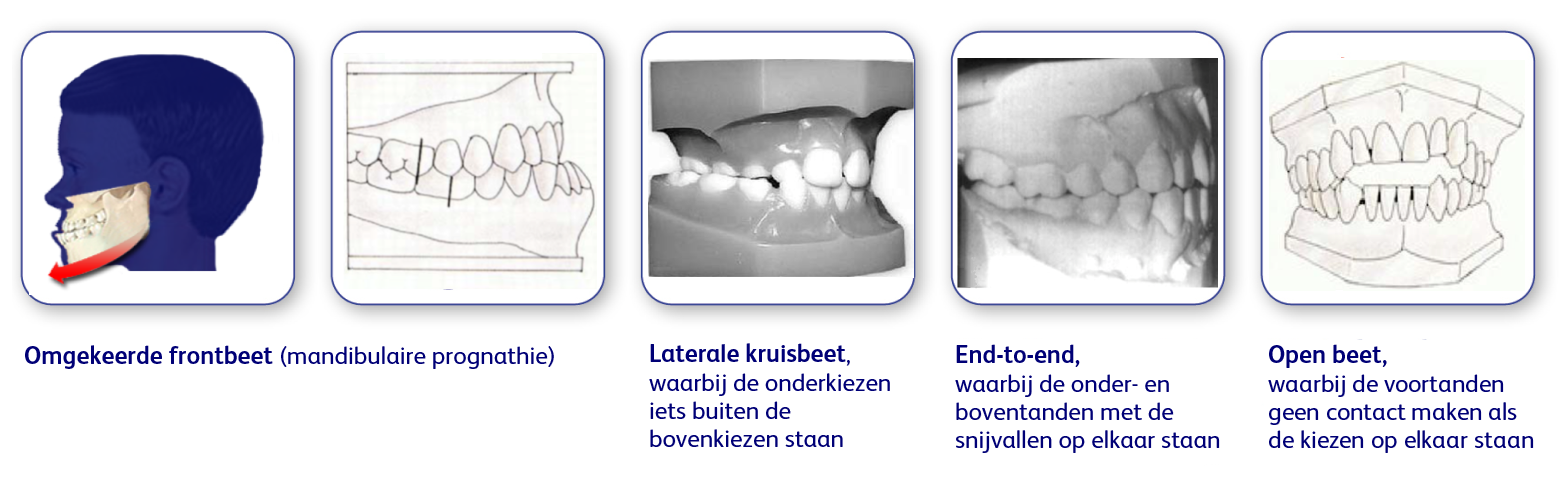 Acromegalie groei kaken, gebit mond