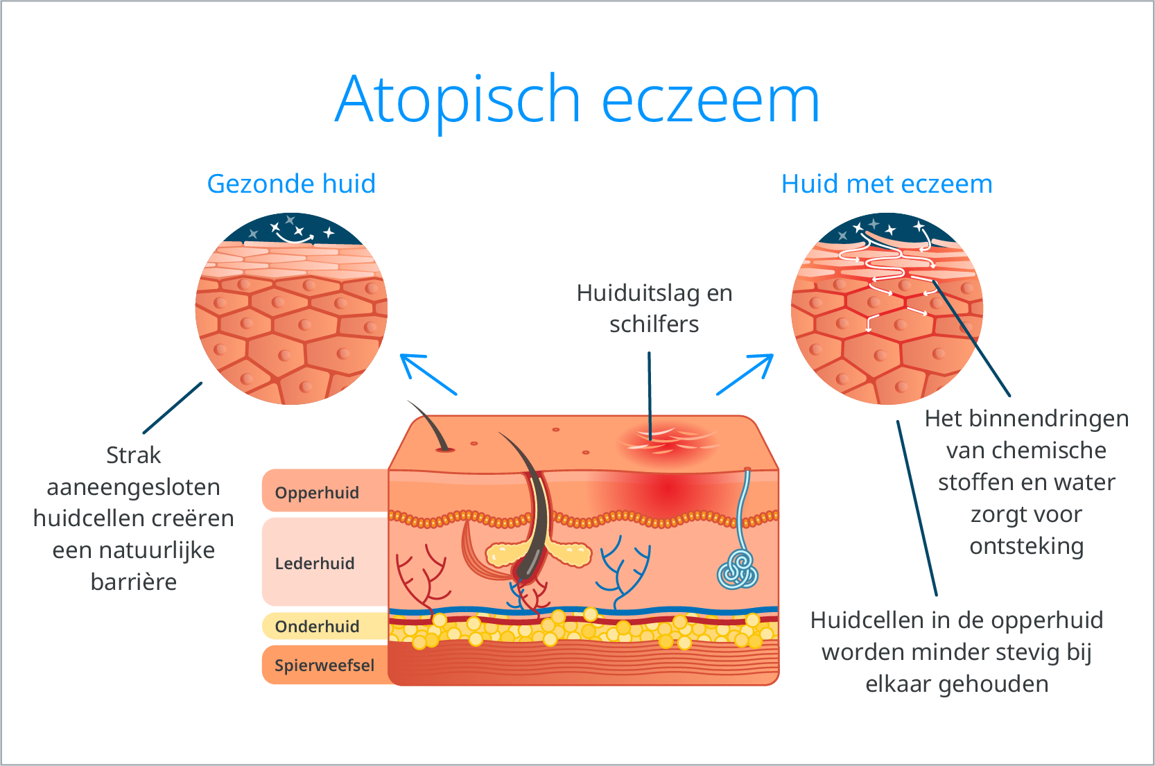 infographic atopisch 