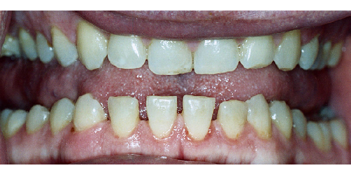 Acromegalie tanden, diastemen, spleetje
