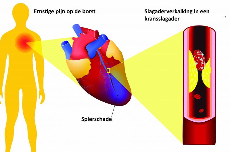 Symptomen Hartaanval Vrouw symptomen 2020