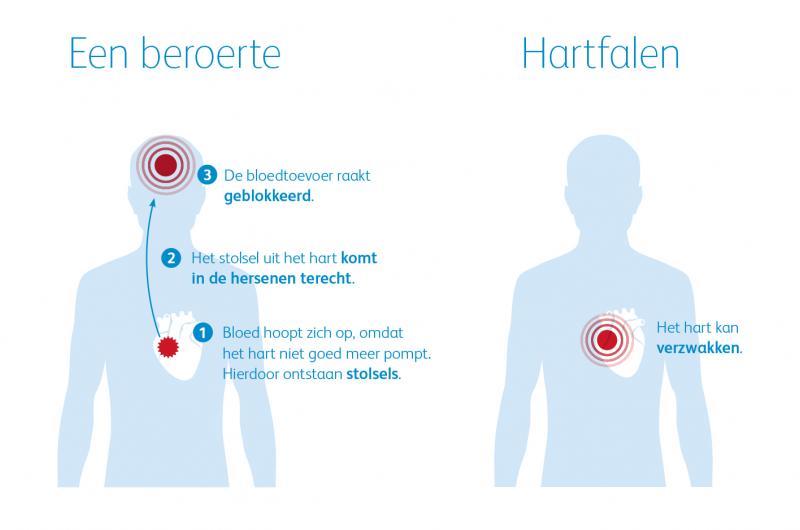 Infographic Een beroerte en Hartfalen | Pfizer Nederland