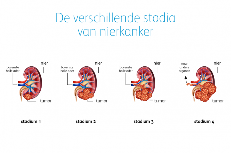 De verschillende stadia van nierkanker | Pfizer Nederland