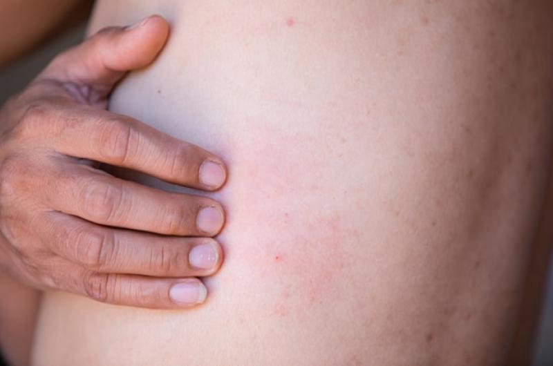 Wanneer loop je risico op een schimmelinfectie?