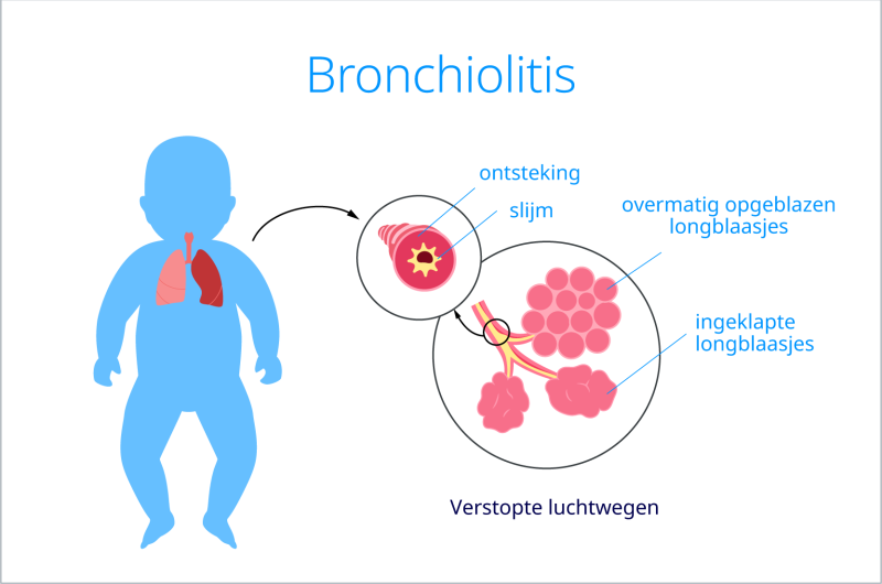 bronchiolitis baby